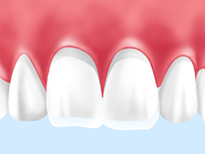 歯の連結 